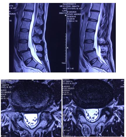 腰椎核磁示:腰4椎体滑脱伴腰4/5椎间盘突出.