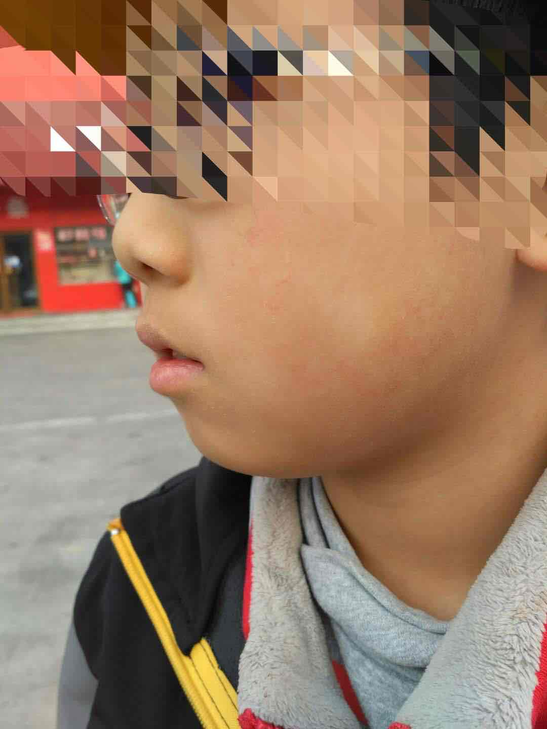 儿童面部的白斑,很多时候是白色糠疹