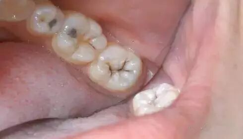 牙齿上的小黑点我们要怎么处理