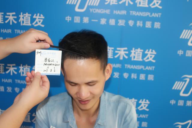 植发6个月告别秃顶重现茂密头发