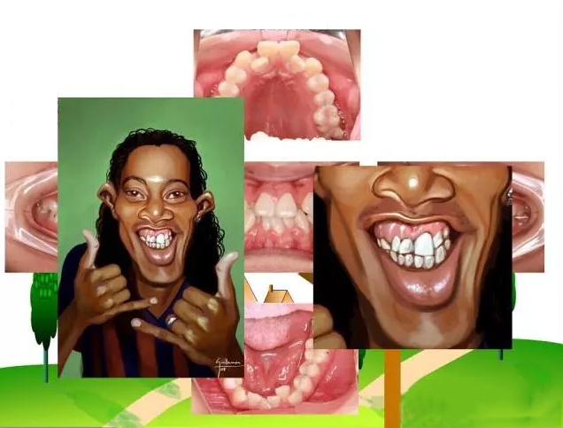 口呼吸,吐舌,咬唇,张口等的口腔不良习惯造成了牙齿的错颌畸形