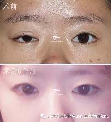 上睑下垂修复价格高不高?