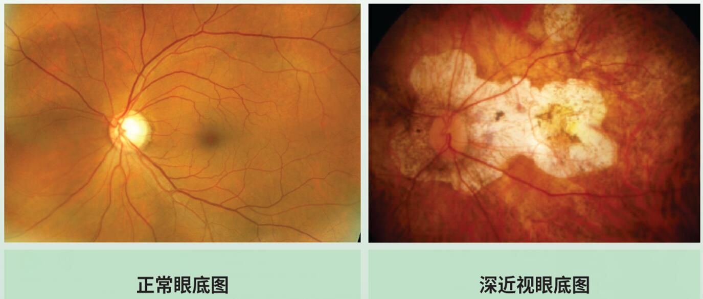 高度近视的孕妈妈们记得要进行眼底检查,如果没有眼底病变,高度近视是