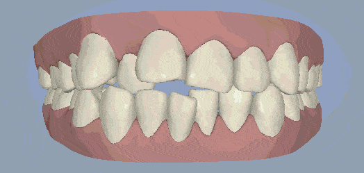 牙齿矫正的过程和原理到底