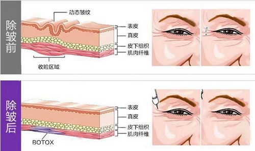 肉毒素不止除皱瘦脸,还能瘦肩瘦腿和抑汗