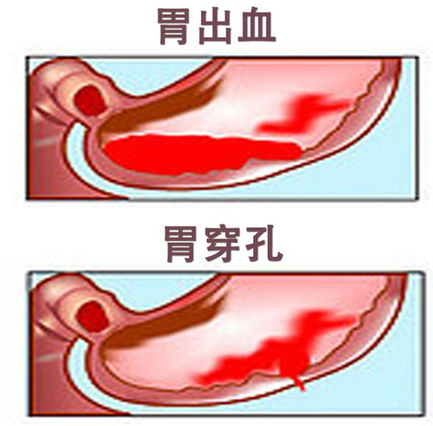 得了胃癌开腹手术vs腹腔镜手术哪个更好