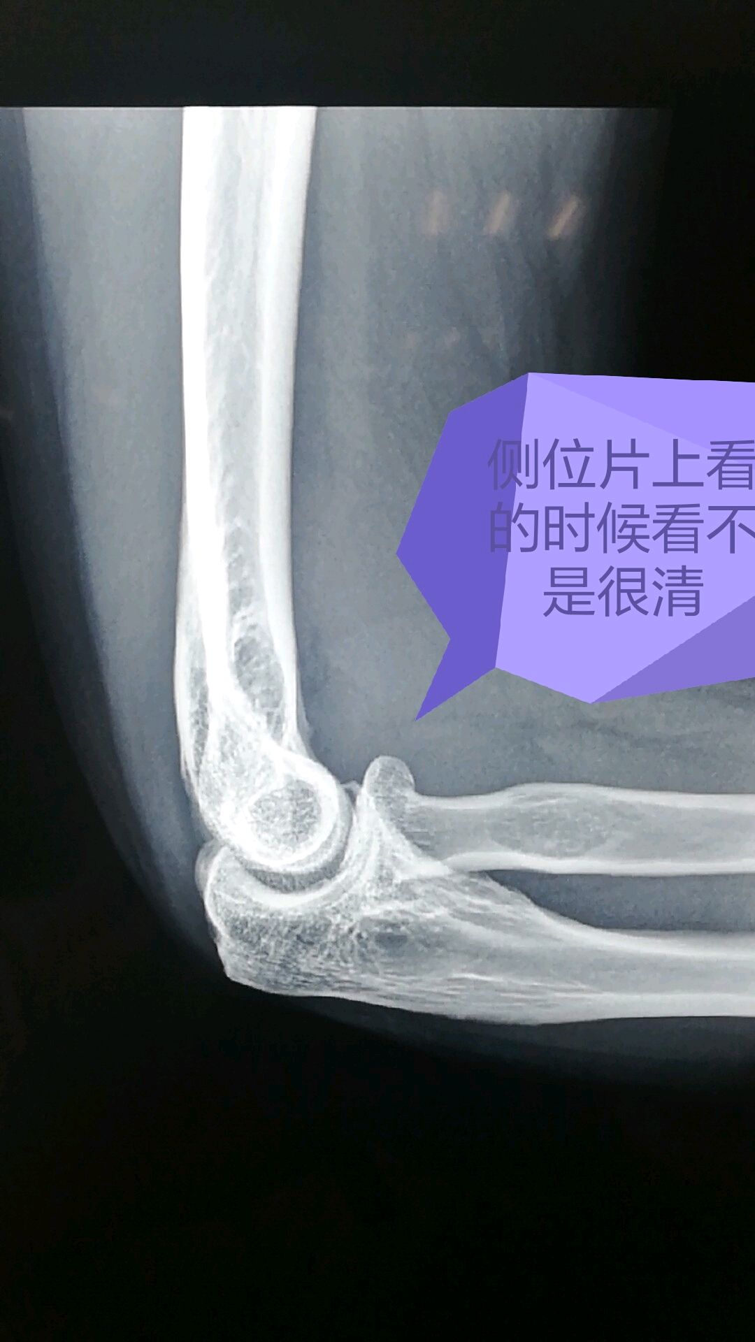 82岁的骨折病人 如何从双下肢无力到恢复行走功能？__中国医疗