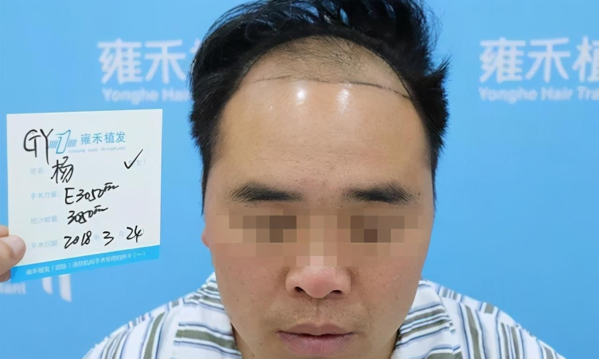 天生发际线高怎么办,植发有用吗?
