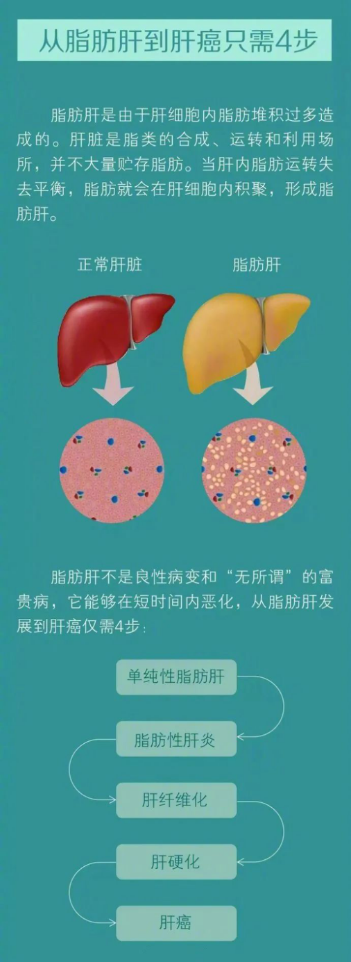 从脂肪肝到肝癌只需4步为肝脏科学瘦身你需要这样做