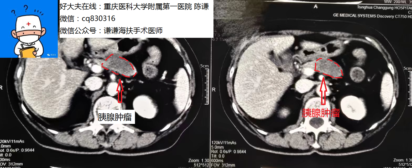 胰腺癌的海扶刀超声消融治疗