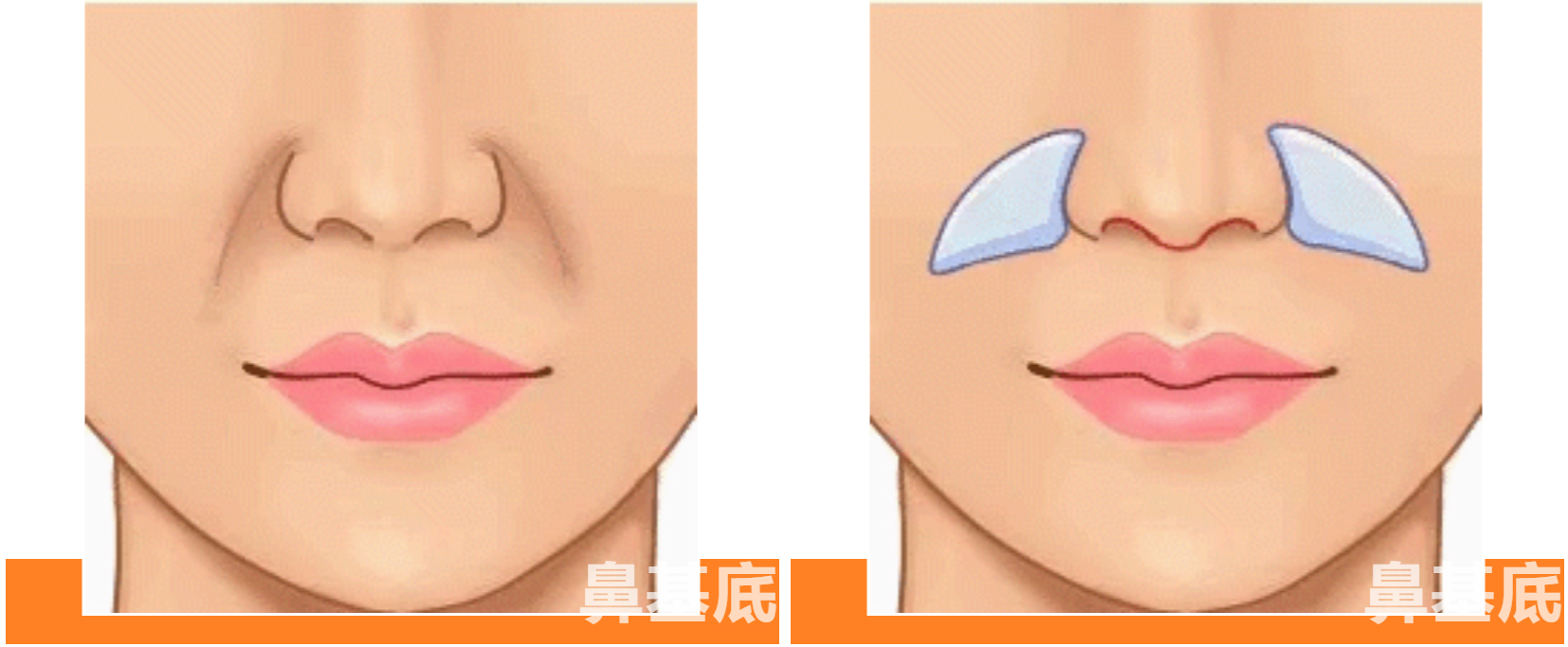 鼻基底凹陷有多吃亏?