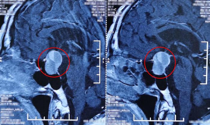 神经内镜下经鼻蝶入路手术切除一例颅咽管瘤,一例垂体