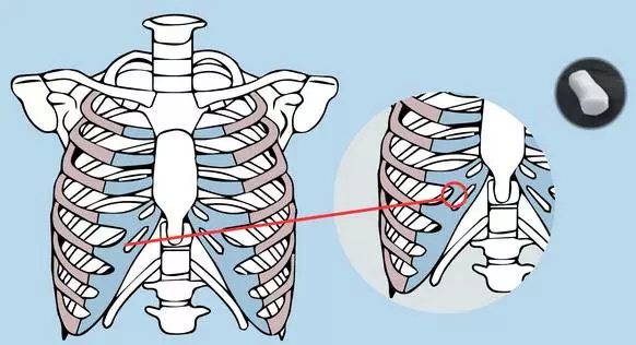 肋软骨 肋软骨也是透明软骨,联结着骨性肋骨和胸骨,虽然它呈乳白色并