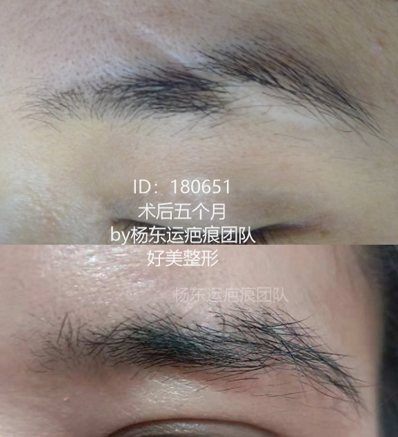断眉的修复术后5个月
