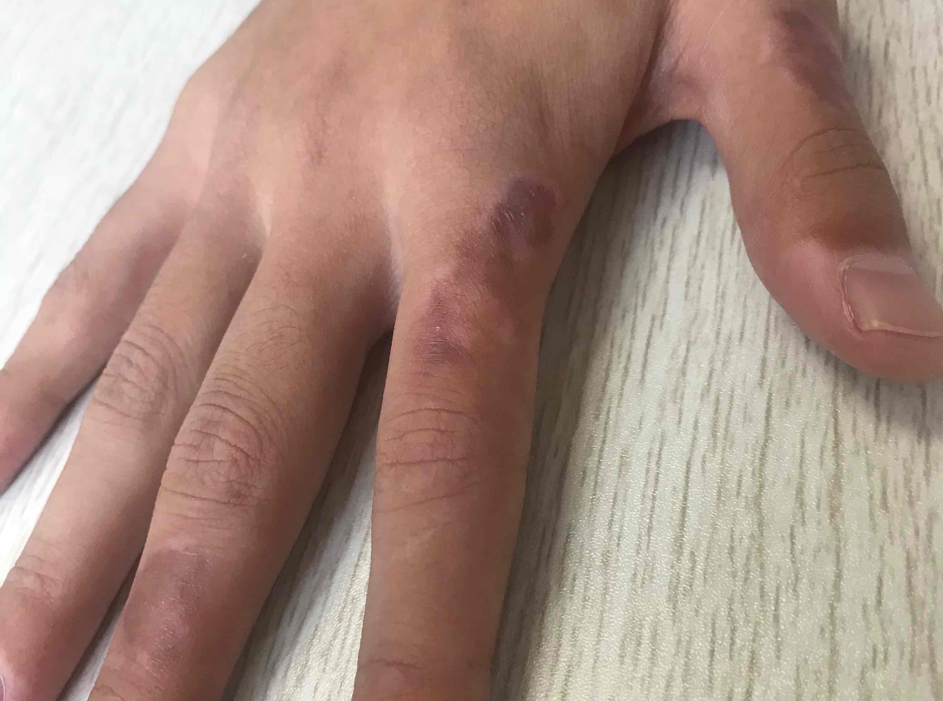 因为肢端型白癜风较为难治愈,所以在治疗上除了药物治疗,各项物理治疗