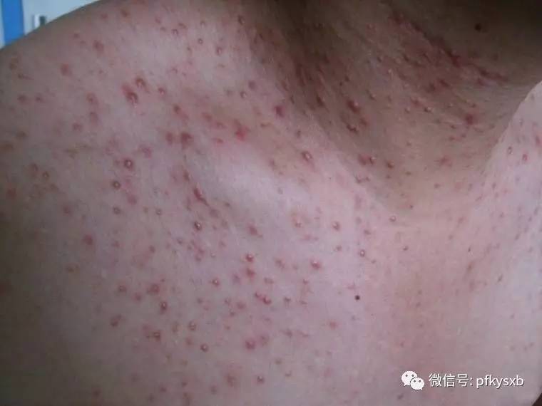 夏季常见皮肤病之二:伪装成痘痘的糠秕孢子菌毛囊炎