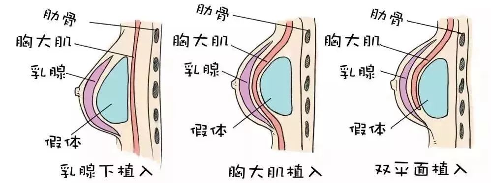 隆胸一般放置的位置静态3d隆胸技术根据女性运动时胸部曲线的变化数据