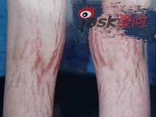 库欣综合征的护理