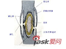 慢性化脓性骨髓炎简介