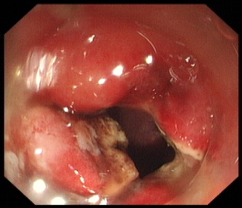 胃窦部肿瘤图片图片