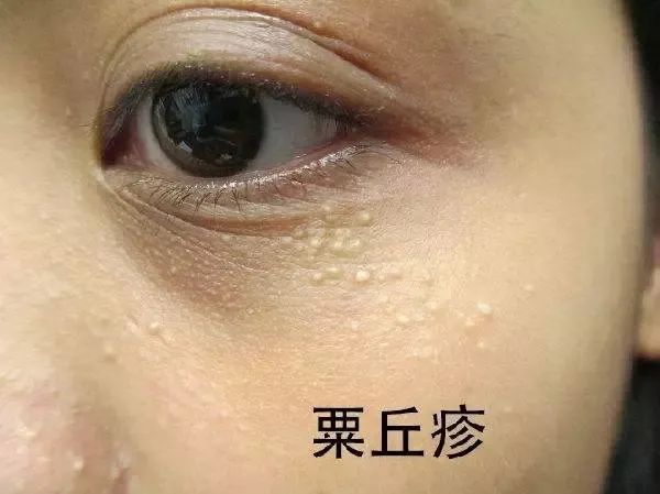 大多生長在眼睛的周圍,而白頭粉刺多生長在額頭和下巴,黑頭粉刺多生於