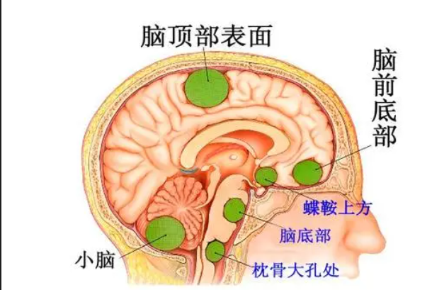 脑膜瘤多在颅内好发于静脉窦旁,大脑镰,蝶骨脊,桥小脑角,小脑幕,鞍