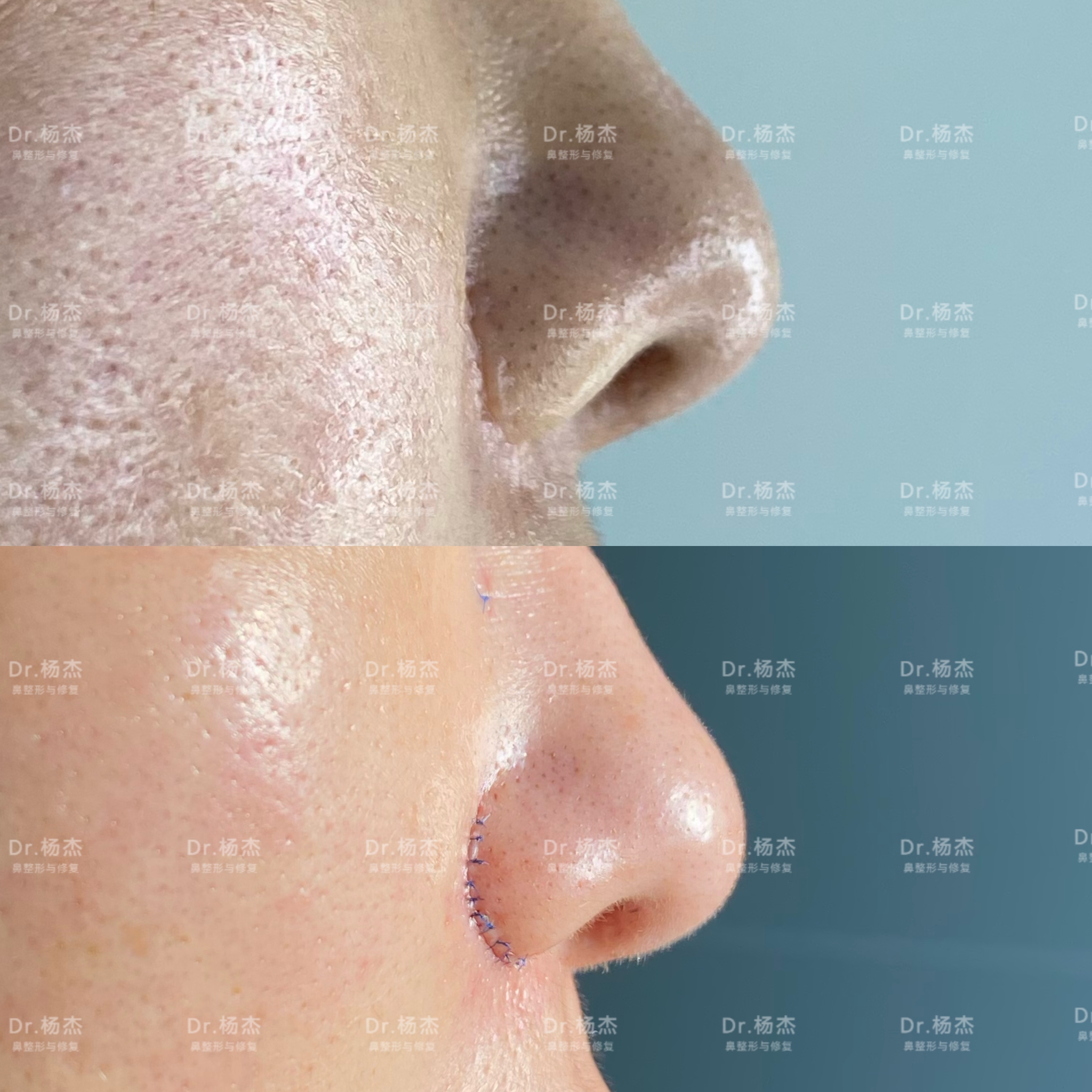 第一次鼻子CO2点阵激光祛痘疤和祛痣记录（更新20200628） - 知乎