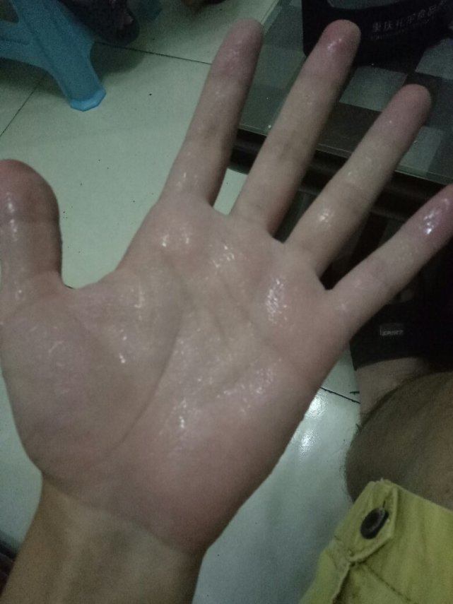 夏天手脚老是出汗-李杨主治医师-爱问医生