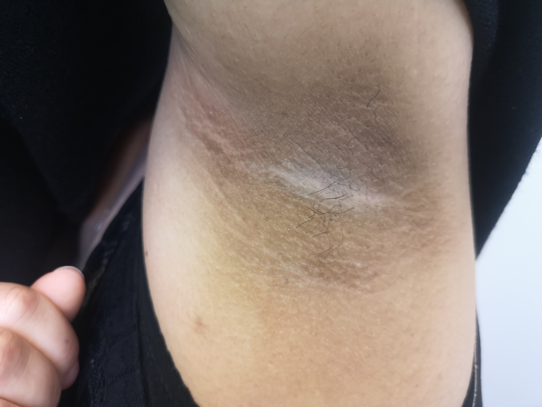 如黑棘皮病除了部分是内分泌疾病,肿瘤等引起,相当一部分和肥胖相关