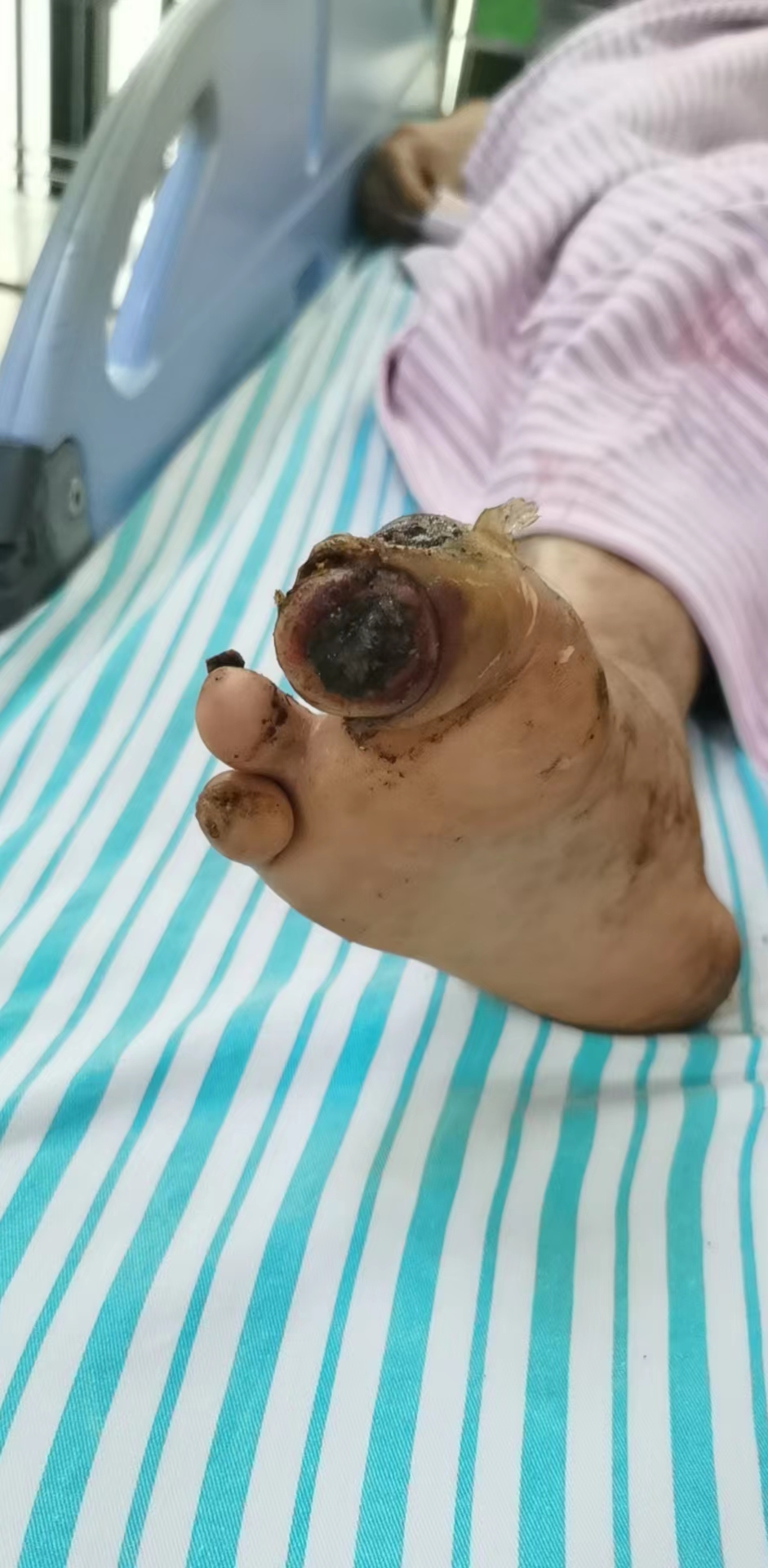 脚趾头坏死了怎么回事