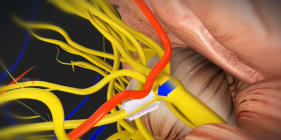 的骨窗,显微镜下于右侧桥小脑角区探查三叉神经,见右侧小脑上动脉压