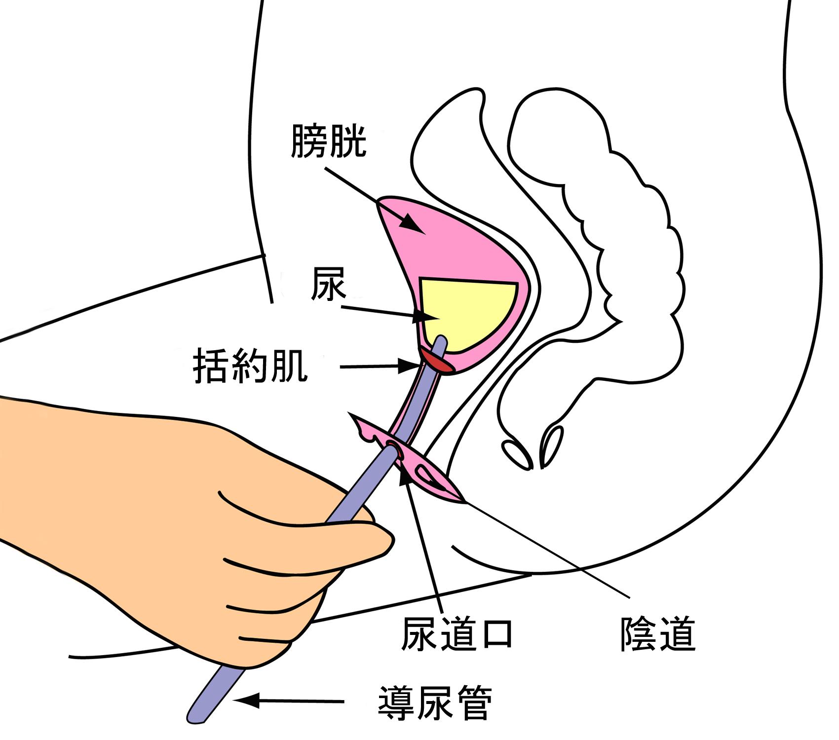 女患者导尿术流程图片