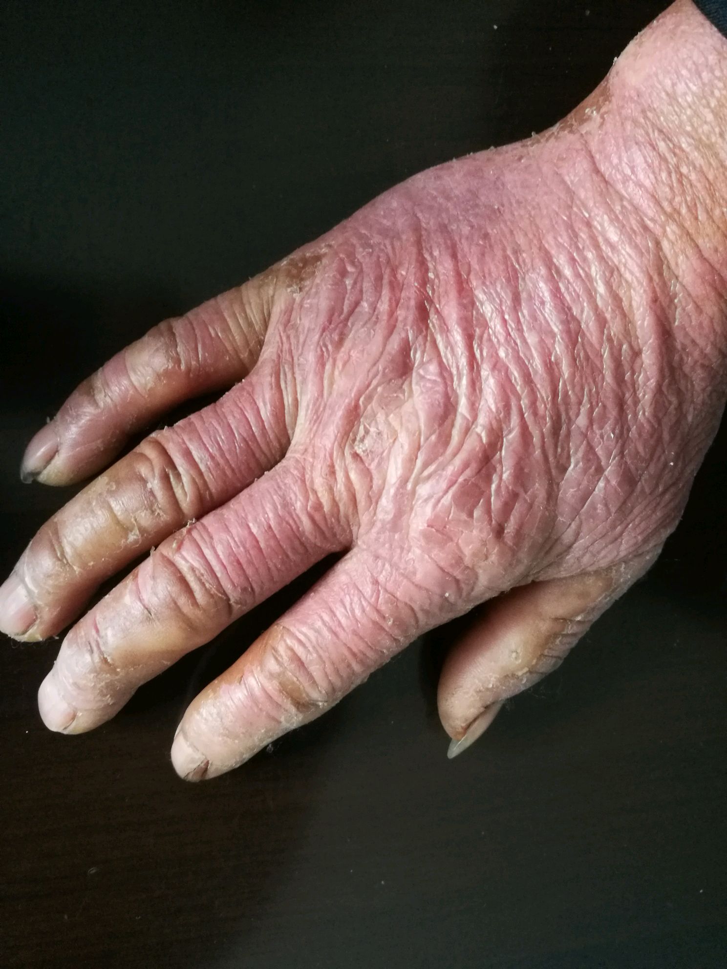 一种容易被病人甚至专科医生忽略的光线性皮肤病.