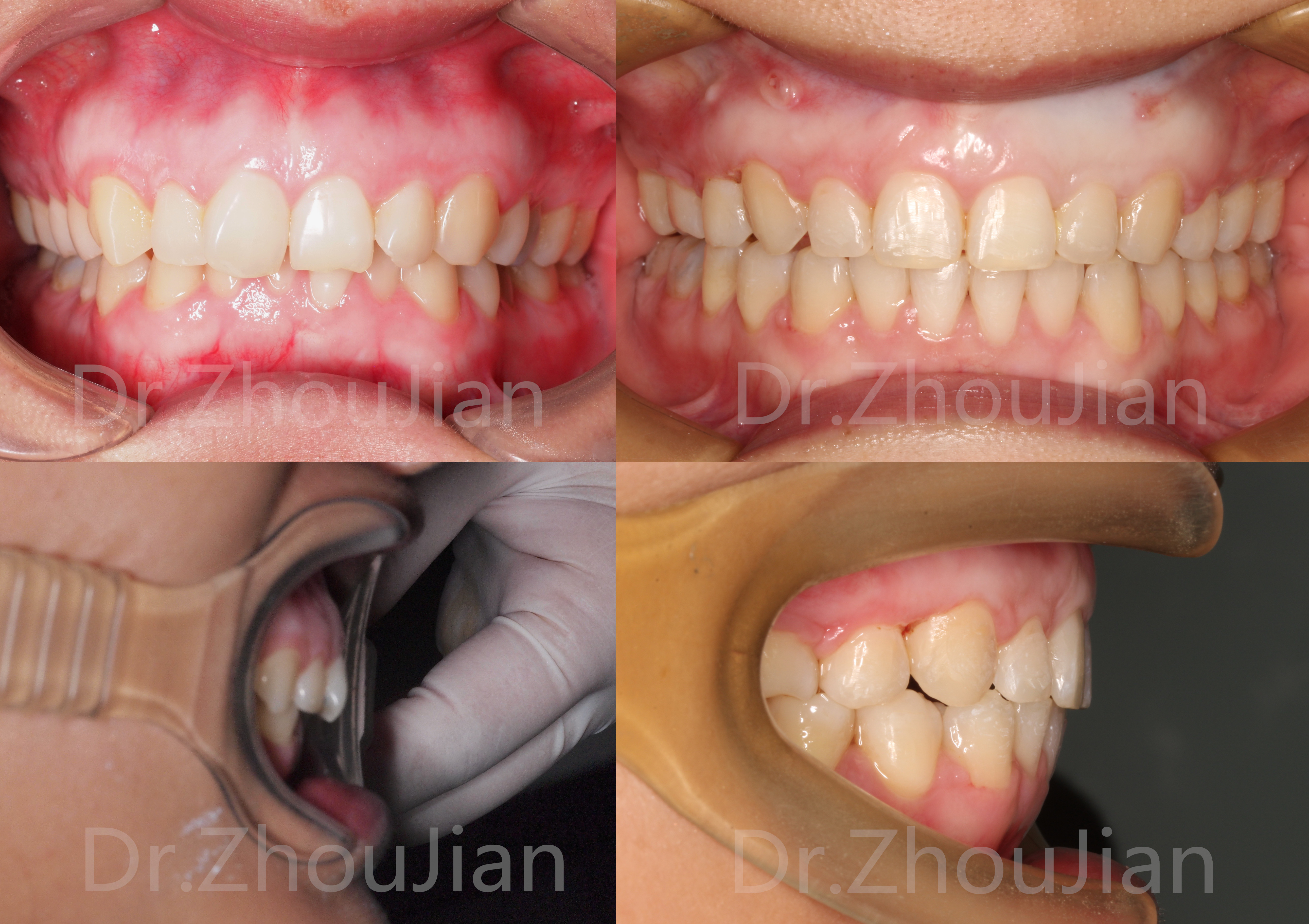 不仅影响美观 还将影响牙齿咬合