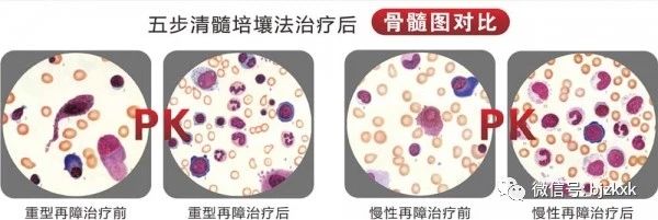 再生障碍性贫血的三大常规治疗方法,和最有效的治疗方法.