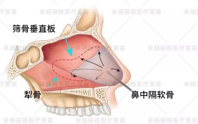 千万别取鼻中隔图片