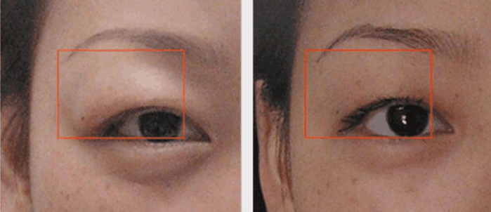 眼睛肿眼泡你所不知道的是?