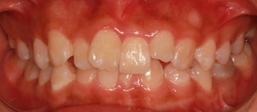 引起牙齿拥挤的原因