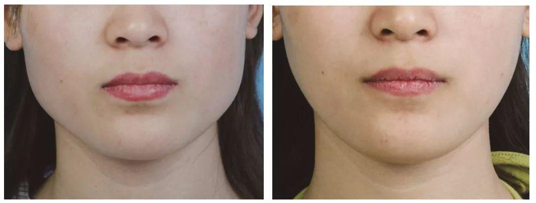 做下颌角会不会出现台阶感