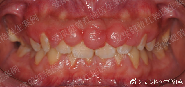 种植牙牙龈增生图片图片