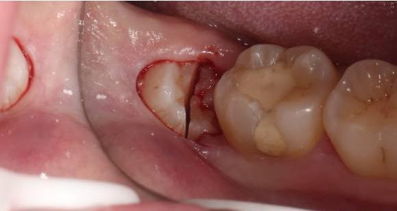 避免的,智齿正常生长还好,但万一遇到阻生智齿则会导致邻牙的牙根吸收