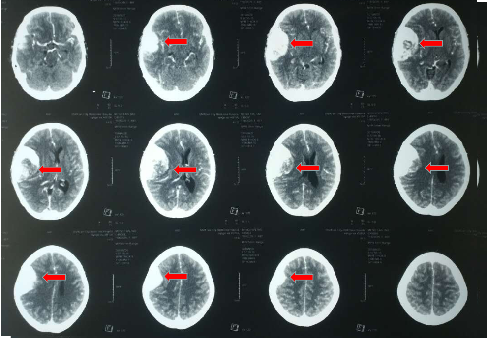 头部ct提示脑出血,中线偏移12mm,大脑