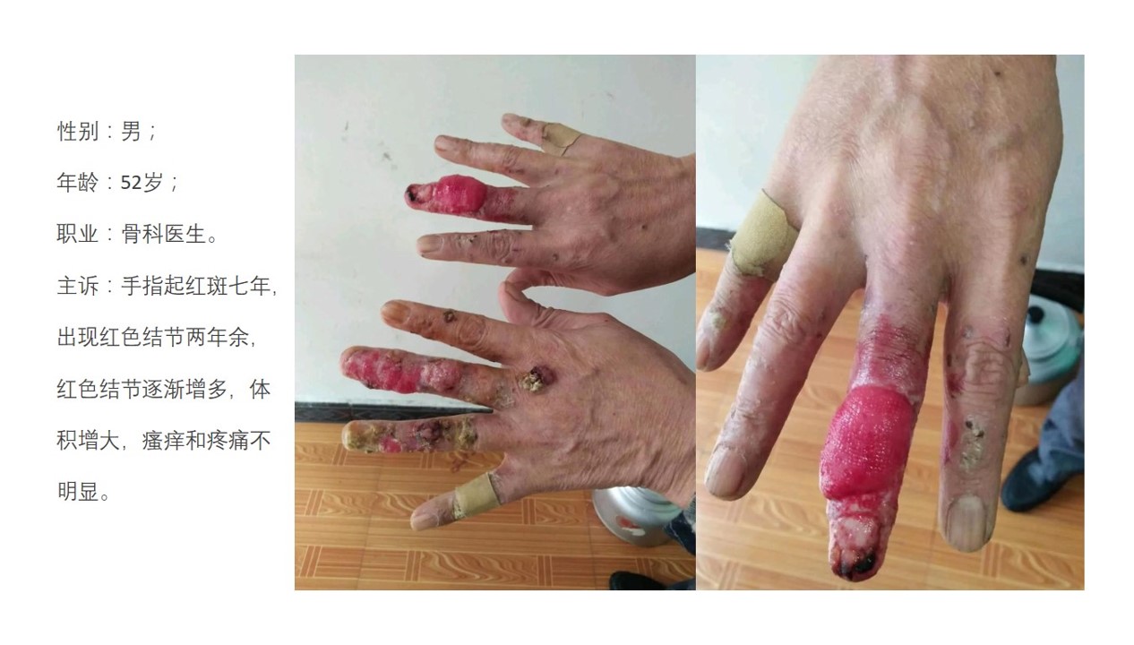 警惕放射性皮炎!-杨希川主任医师-爱问医生