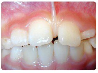 3,唇系带异常:唇系带附着于上排中间两颗门牙之间的外侧牙龈和牙槽