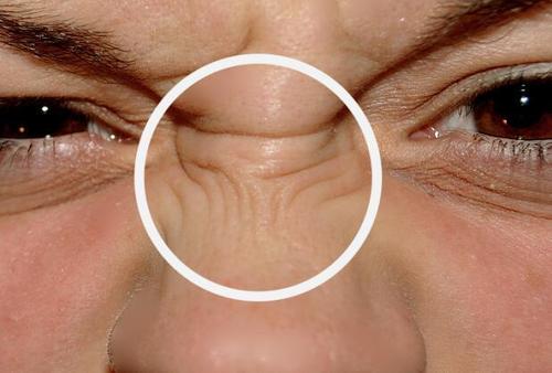 鼻子为什么会出现皱纹该如何进行治疗