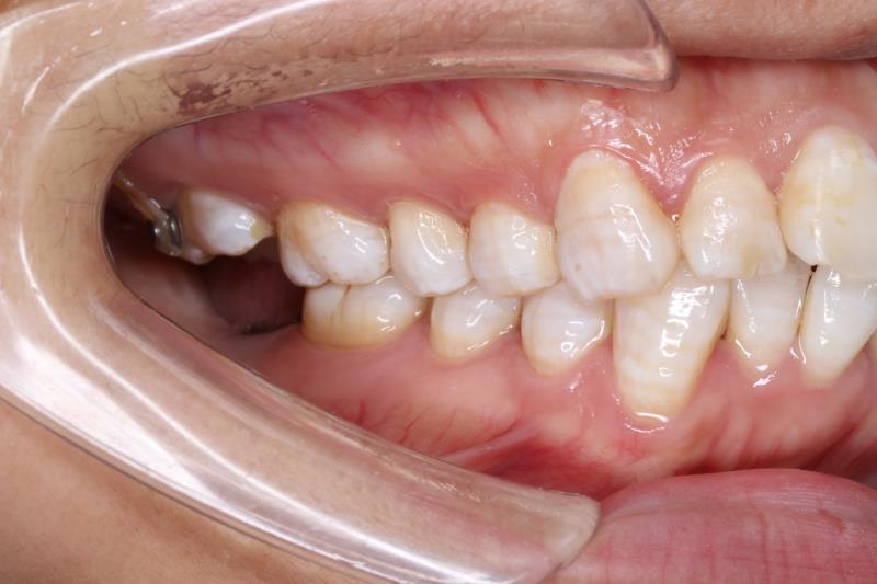 压低磨牙的毕业季-林范主治医师-爱问医生