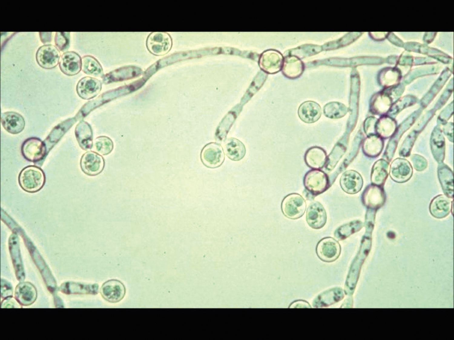 白假丝酵母菌镜下图图片