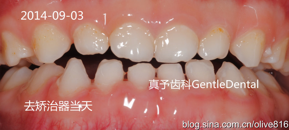 乳牙反合联冠斜导矫正过程照片一例