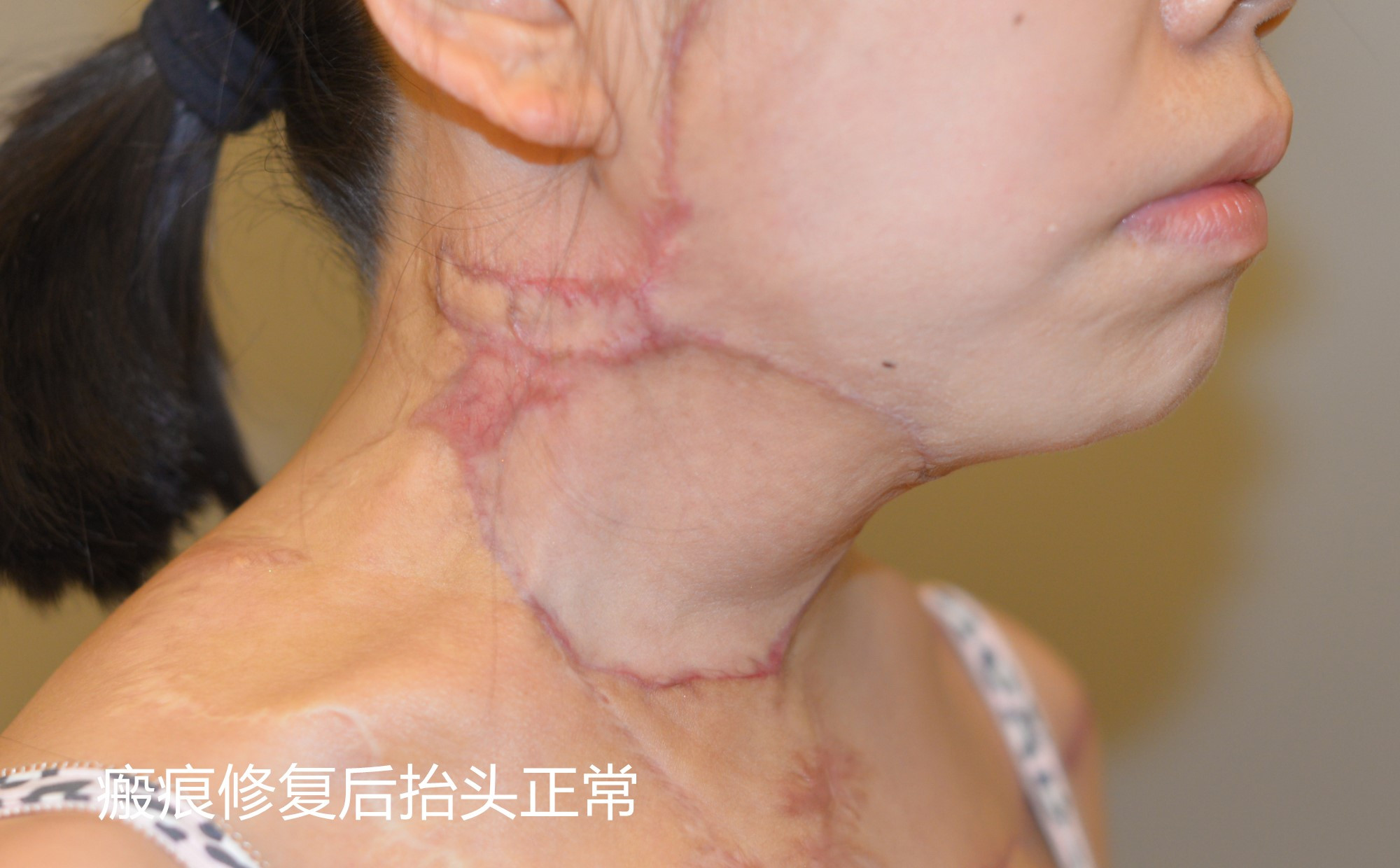 瘢痕修复案例带你了解神奇的扩张器