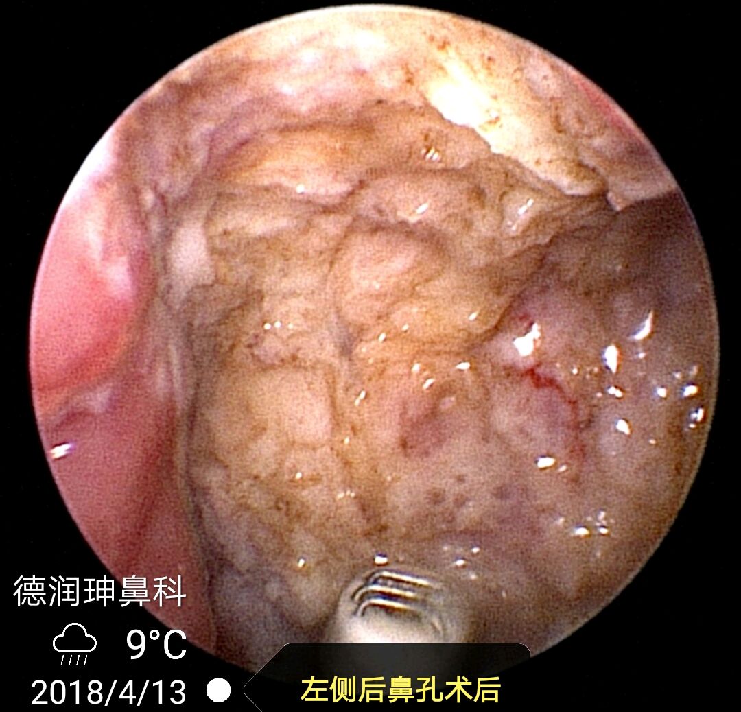 患兒的媽媽是我在同仁醫院時的慢性鼻竇炎鼻息肉患者,術後近十年都